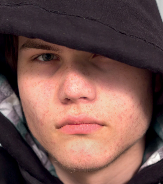 head shot image of a sad young teenager with acne.