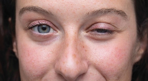 Close-up van het gezicht van een jonge vrouw met blauwe ogen, waarvan één oog halfgesloten is vanwege myasthenia gravis.